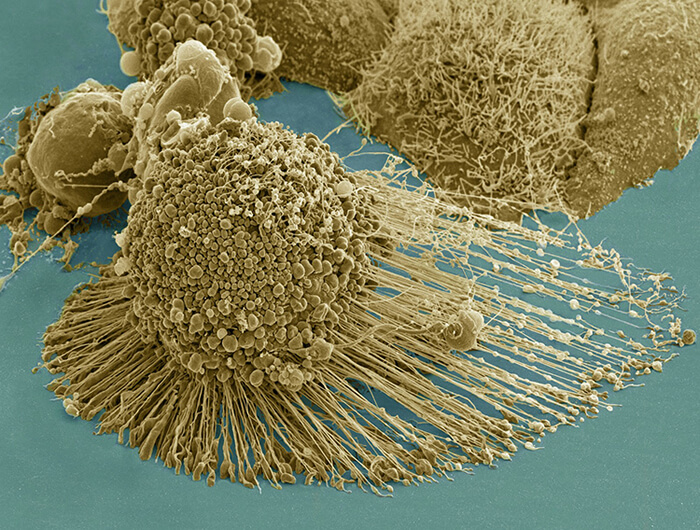 Scanning Electron Micrograph Of An Apoptotic HeLa Cell